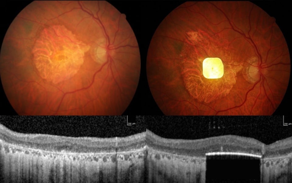 Mắt bên trái được cấy ghép chip hỗ trợ thị giác Chip Prima cấy vào mắt trái